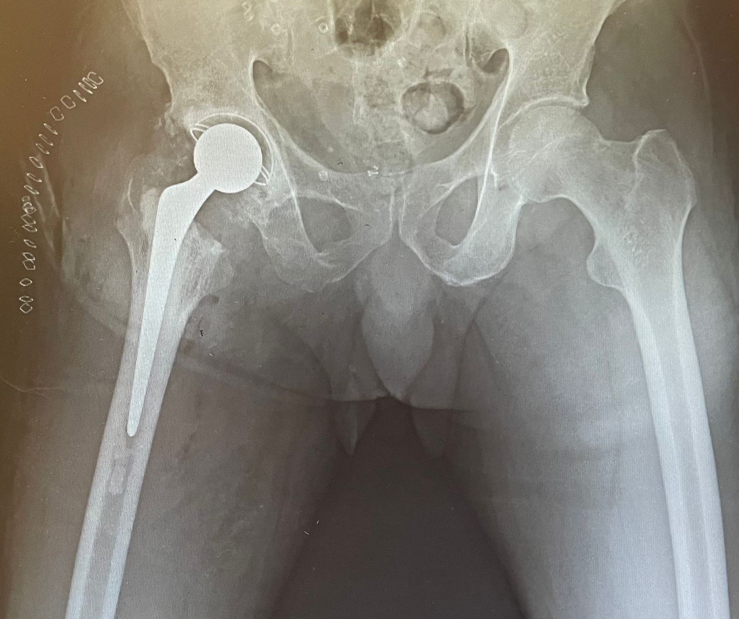 Hip-replacement-surgeon-in-faridabad